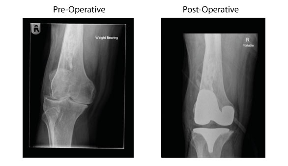 custom_knee_op